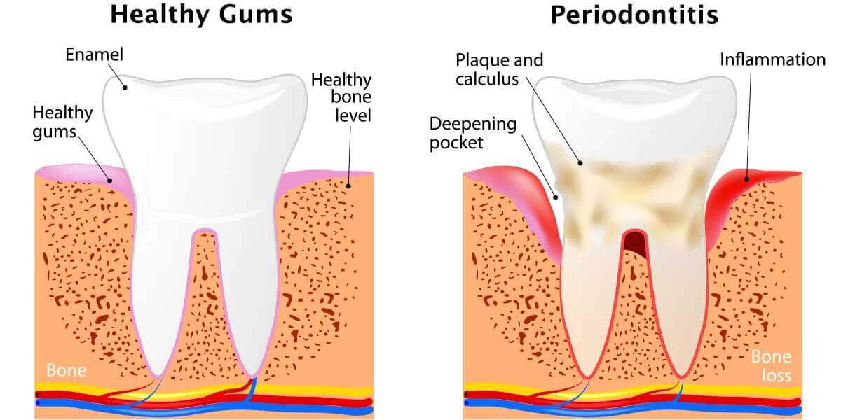 Periodontal Disease Stages