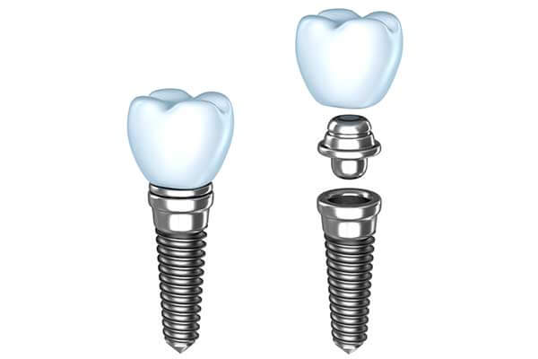 Implants Graphic Illustration